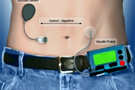 Искусственная поджелудочная железа появится в продаже уже в 2016 году- ВИДЕО
