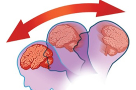Մարդն ուղեղի ցնցումից հետո ավելի երկար է վերականգնվում, քան թվում է