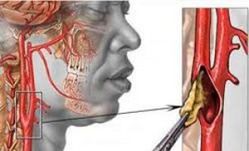 Рабочая группа по профилактическим мероприятиям не рекомендует скрининг стеноза сонных артерий у бессимптомных пациентов