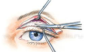 Операция на веках избавляет от головных болей