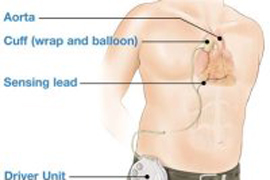 Имплантируемое устройство контрпульсации оказалось эффективным в лечении сердечной недостаточности