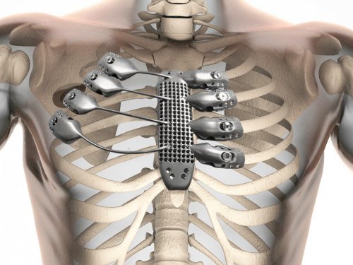 Революция в хирургии: больному раком имплантировали 3D-ребра
