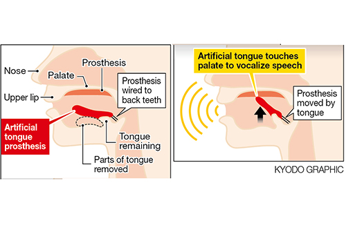 Ճապոնացի գիտնականները մարդու լեզվի պրոթեզ են փորձարկում. 1in.am