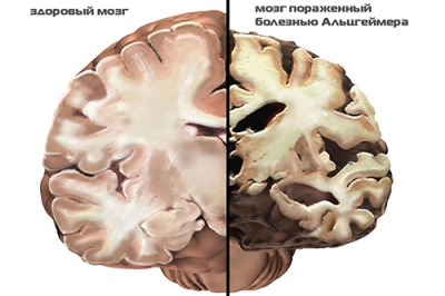 Ալցհեյմերի հիվանդություն. ultraimaging.am