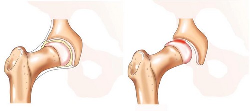 Ազդրի բնածին հոդախախտ. izmirlianmedicalcenter.com