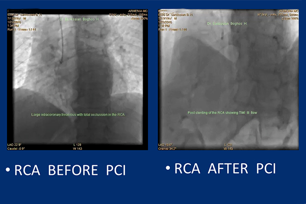 Աջ կորոնար զարկերակի (RCA) ռեվասկուլյարիզացիա և ստենտավորում «Stent for life» ՀՀ պետծրագրի շրջանակում. armeniamedicalcenter.am