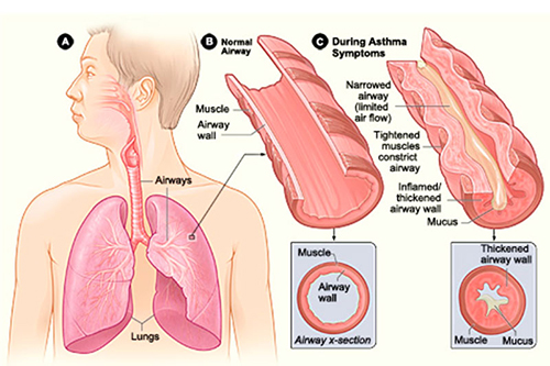 Врачи установили, что отвечает за тяжесть астматических приступов