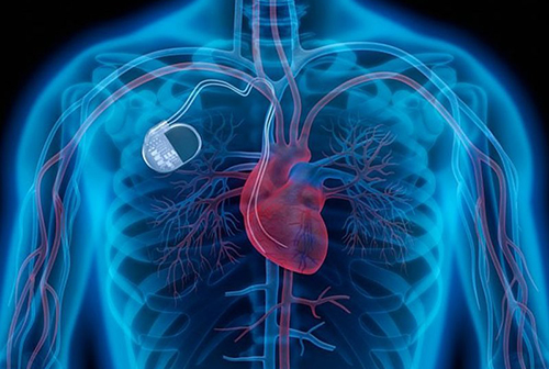 Кардиостимуляторы будут ставить в идеальное место