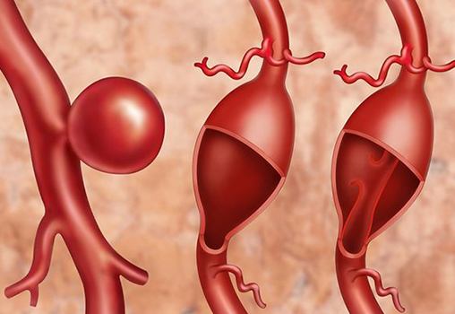 Впервые в мире аневризму удалила роботизированная система