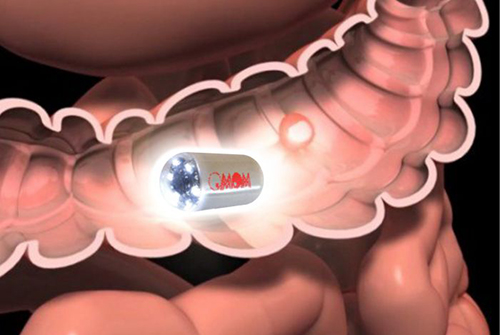 Видеокапсула позволяет исследовать кишечник без дискомфорта