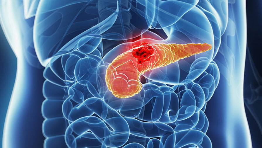 Сортилин может стать ключом к более эффективной борьбе с раком поджелудочной железы