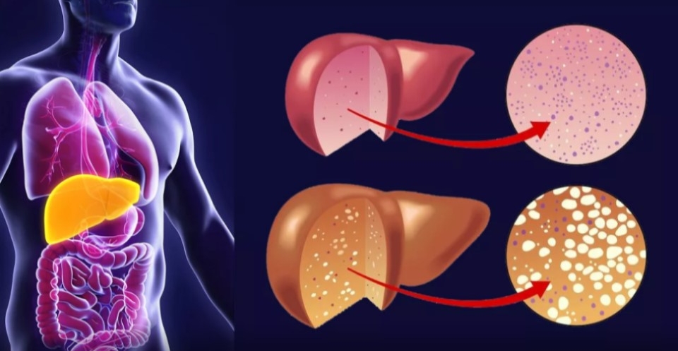 Жировая болезнь печени: ее неочевидный признак легко увидеть во рту
