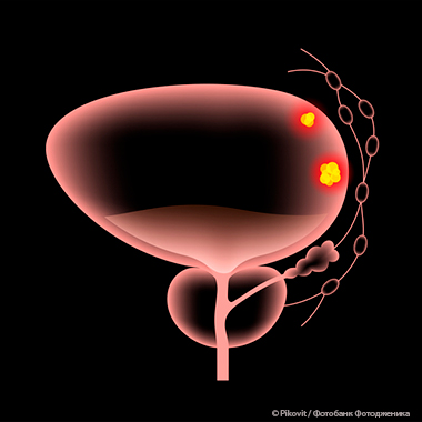 Одобрены новые клинические рекомендации по ведению пациентов с раком мочевого пузыря
