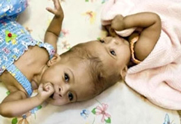 Գլխի հատվածում միացած սիամական երկվորյակներին անջատել են իրարից