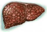 Обнаружены новые возможности лечения фиброза печени