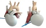 Новое клиническое исследование будет изучать новый размер временного искусственного сердца