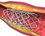 Стентирование повышает риск инсульта и смерти