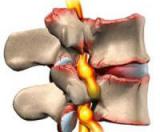 Ученые нашли новые данные о дегенерации позвоночных дисков