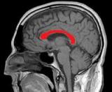 Реставрация связи между полушариями помогает восстановиться после инсульта