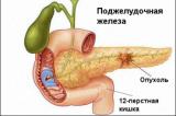 Оживление гена остановит развитие опухолей поджелудочной железы