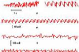 Разработан новый метод диагностики эпилепсии