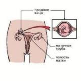 Внематочная беременность. Ее причины