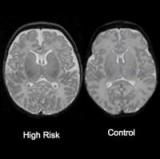 Ученые нашли признаки шизофрении в структуре мозга младенцев