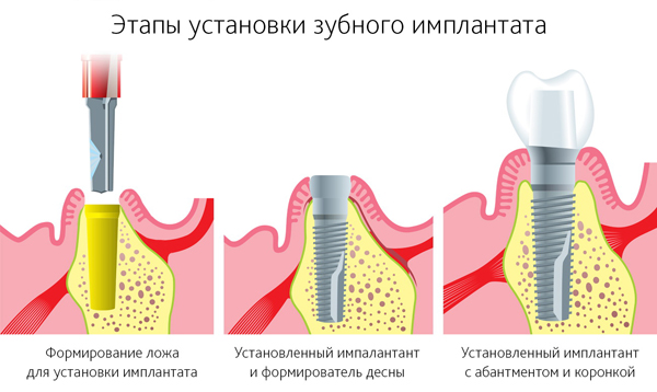 Ատամների իմպլանտացիայի փուլերը. mis-armenia.am