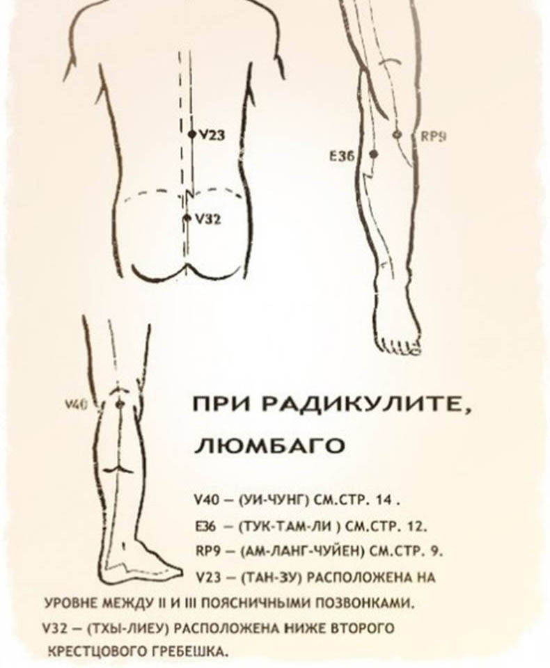 радикулит