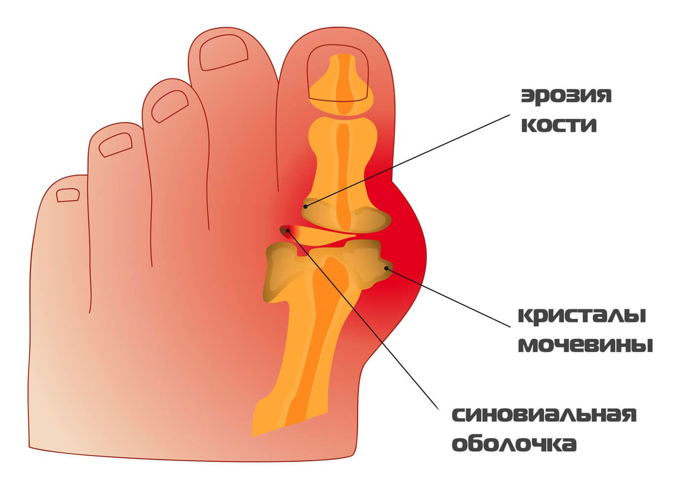 Как снизить уровень мочевой кислоты? мочевая кислота