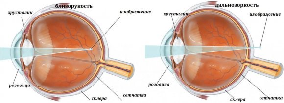  строение глаза при дальнозоркости и близорукости