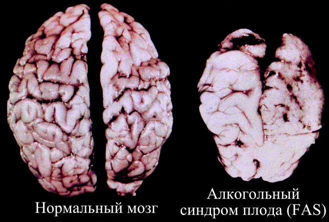 Алкогольный синдром плода