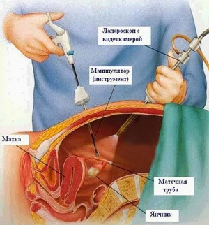  Фибромиома матки и операция