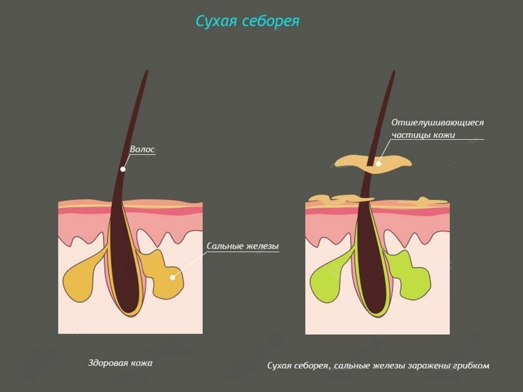  Лечение себореи