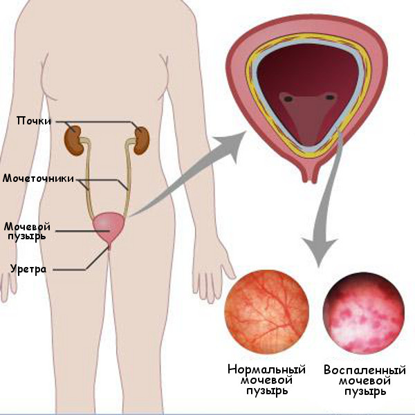 Симптомы цистита