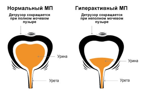 Гиперактивный мочевой пузырь