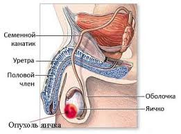  рак яичка