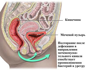 Симптомы цистита