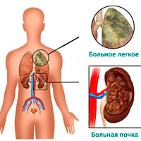 Синдром Гудпасчера – главное открытие стипендиата Фонда Рокфеллера