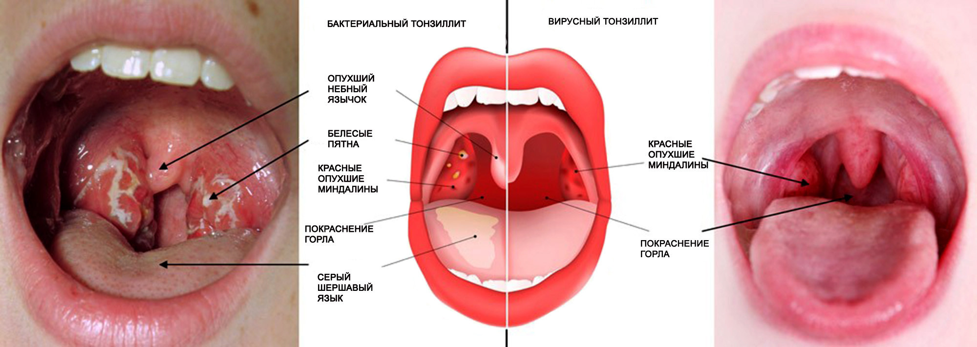 тонзиллит