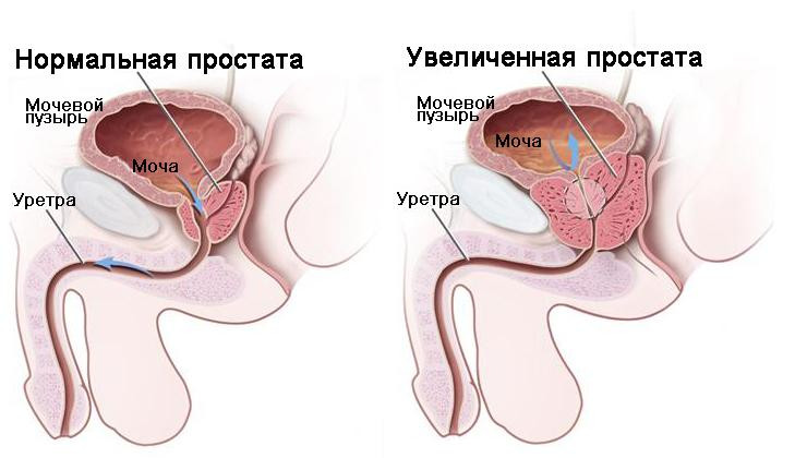 увеличенная простата