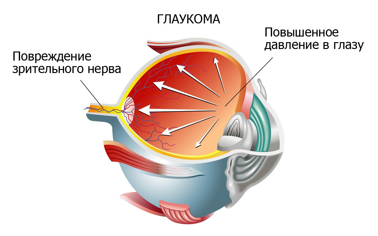 при повышенном внутриглазном давлении