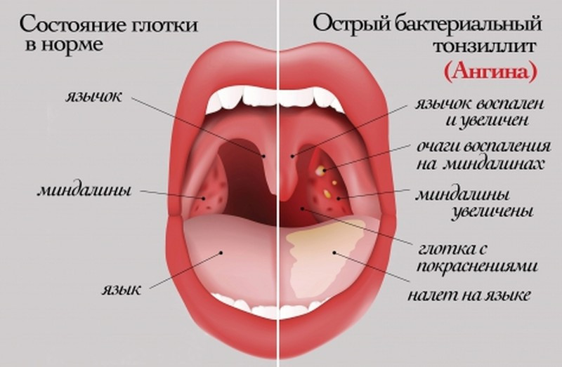 тонзиллит