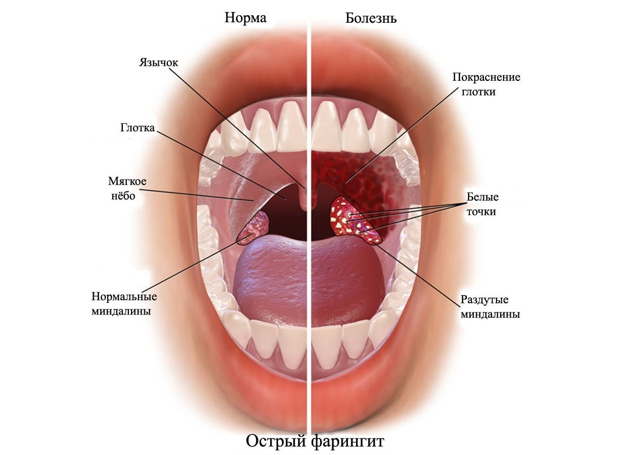 фарингит