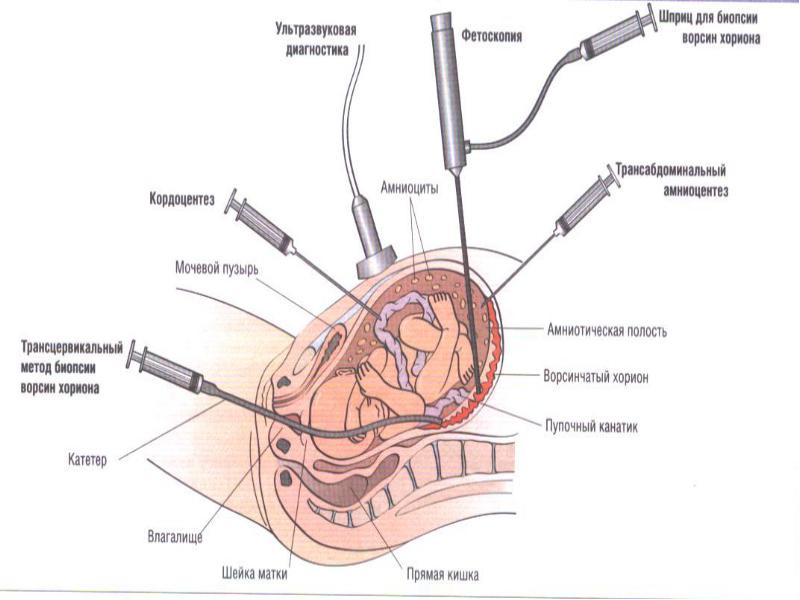 Биопсия ворсин хориона