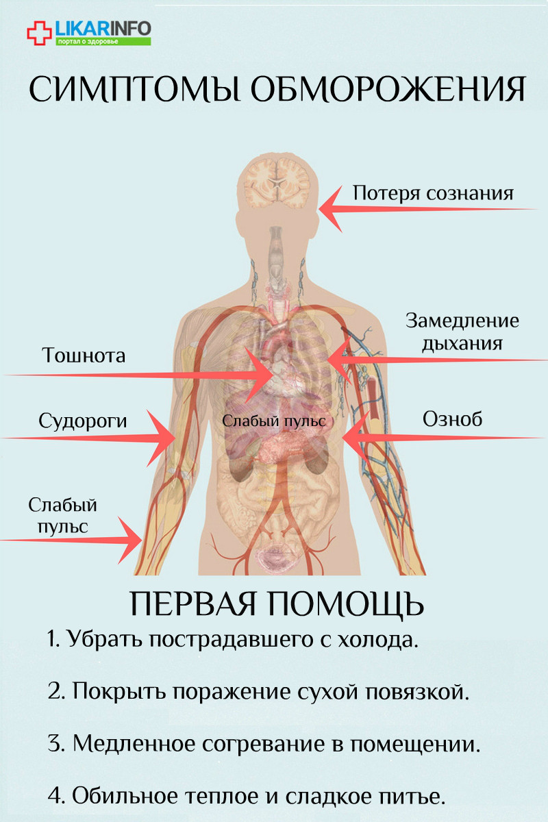 Первая помощь при обморожении - инфографика