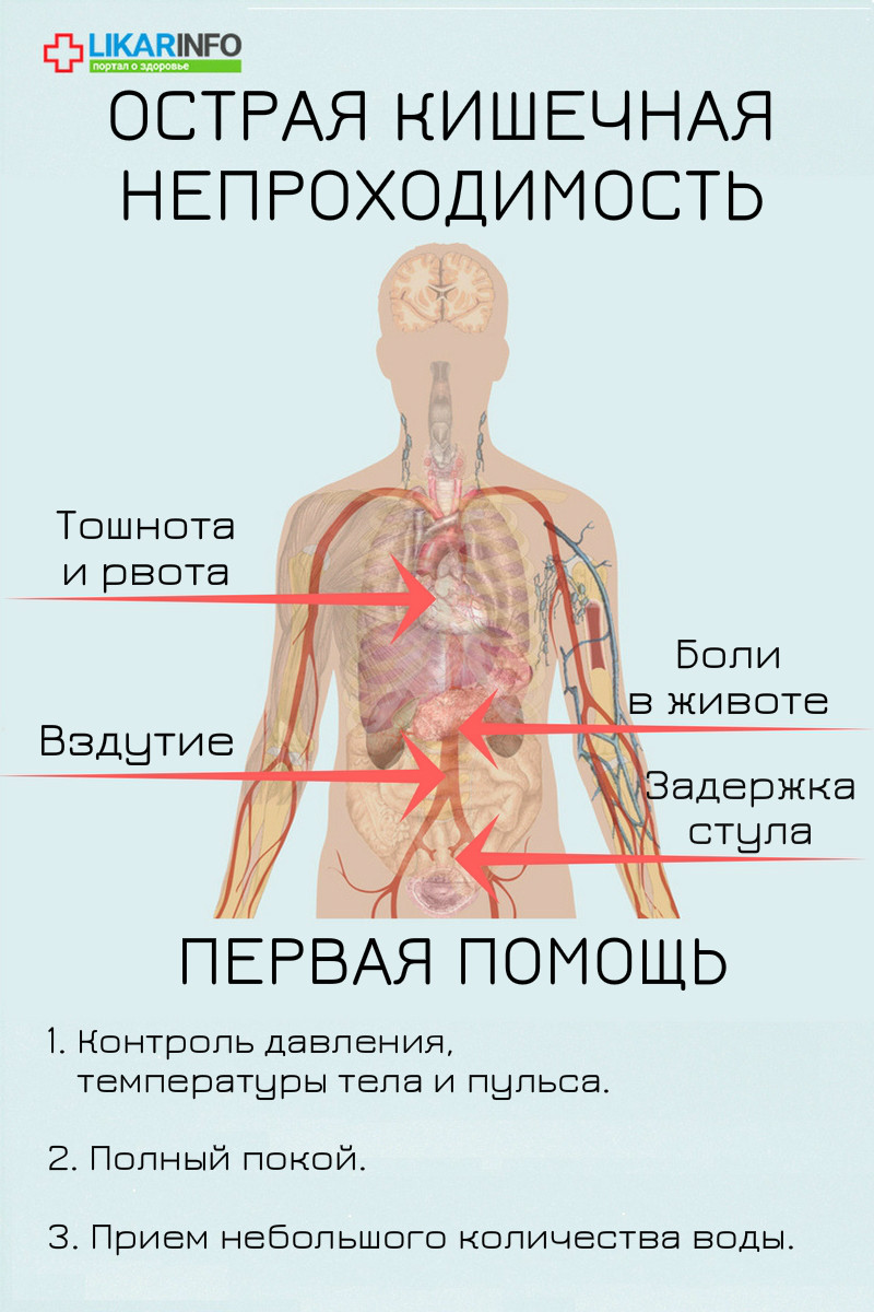 Острая кишечная непроходимость