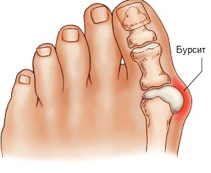 Бурсит большого пальца стопы