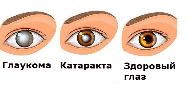 Кому грозит глаукома?