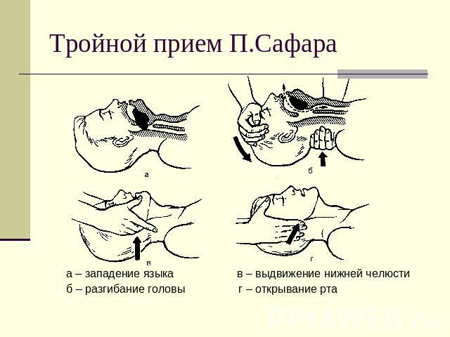  Тройной прием Сафара